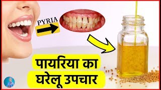 पायरिया का घरेलू इलाज │ Cure for PyriaPyorrhea Gums [upl. by Paschasia]