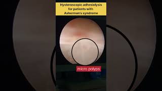 Hysteroscopic adhesiolysis for patients with Ashermans syndrome by Dr Rakshita Malik doctor mbbs [upl. by Sheelah958]