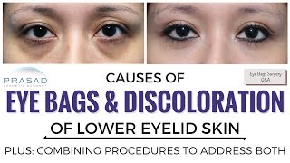 The Causes of Eye Bags and Discolored Lower Eyelid Skin and Treating Both Separately [upl. by Granniah705]