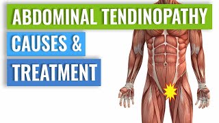 Abdominal Tendinopathy  Causes and Treatment Including Exercises [upl. by Vig]