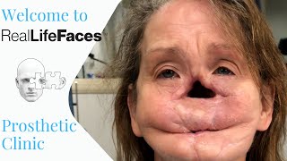 Welcome to Real Life Faces Prosthetic Clinic [upl. by Loma245]