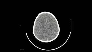 Anoxic brain injury with pseudosubarachnoid hemorrhage [upl. by Aseeral]