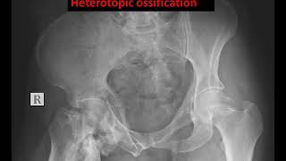 case 572 heterotopic ossification HO [upl. by Osner]