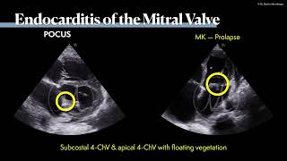 〖Echocardiography〗 Mitral valve endocarditis 🫀 [upl. by Marsiella134]