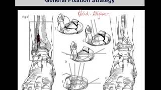 Tibial pilon fractures 2 [upl. by Cannon]