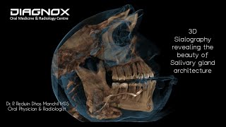 CBCT Sialography of submandibular gland 3D Imaging [upl. by Kalagher]