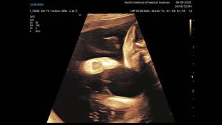 Arthrogryposis Multiplex congenita fetal ultrasound [upl. by Erapsag]