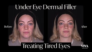 Under Eye Filler Before and After 😴 2021 [upl. by Petr]