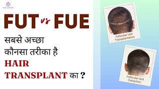 FUE vs FUT Hair Transplantation kya hota hai explained by Dr Arth Shah [upl. by Eirehc]