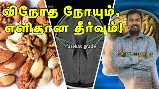 மூளையை பாதிக்கும் வினோத நோய்க்கு தீர்வு  Fazekas grade remedy health brain DrMKalaivanan [upl. by Tsirc]