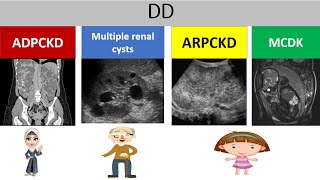 Polycystic kidney disease ultrasound د عمرو صلاح [upl. by Acebber890]