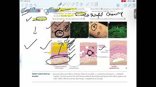 PEMPHIGUS VULGARISBULLOUS PEMPHIGOID [upl. by Shirl]