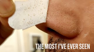 ASMR blackhead removal nose strip on face for skincare satisfying [upl. by Eelam]