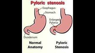 Pyloric stenosis Fluid calculation mrcpch Recall Communication [upl. by Lamiv]