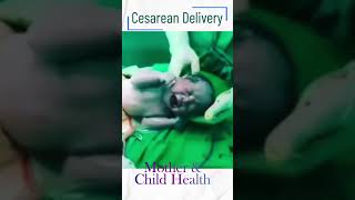 Csection  Cesarean Delivery [upl. by Wharton]