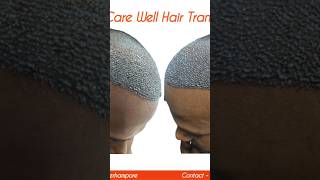 haircare hairlossttreatment besthairtransplantresults hairtransplantclinic hairtransplant [upl. by Meier]