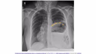 Chest Trauma Pulmonary Contusion amp Diaphragmatic Rupture [upl. by Amund]