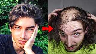 24 Year Old Model Had A Transplant But Stopped Taking Hair Loss Meds And This Is What Happened [upl. by Yvel]