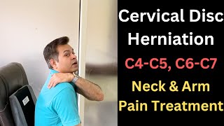 Cervical Disc Herniation C5C6 Neck and Arm Pain Cervical Symptoms Cervical Radiculopathy [upl. by Aziram]