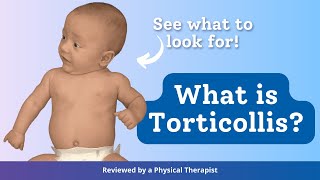 What is Torticollis [upl. by Connor]