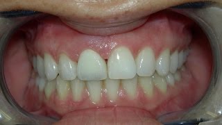 Cosmetic Dentist Recement Fallen Veneer [upl. by Leontine]