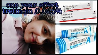 Tretinoin cream 0025 effects after one year [upl. by Halullat]