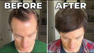 How I Reversed My Hair Loss  Greying [upl. by Beaner]