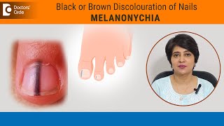 Black lines in nails Streaks on NailMelanonychia Causes amp TreatmentDrRasya DixitDoctors Circle [upl. by Happy574]