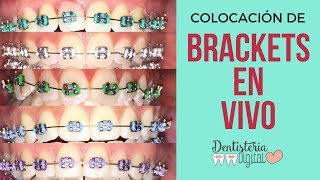 COLOCACIÓN DE BRACKETS EN VIVO  Putting on Braces  LIVE [upl. by Ahsiatal]