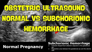 Obstetric Ultrasound Normal Vs Subchorionic Hemorrhage SCH  Early amp Mid Pregnancy Bleeding USG [upl. by Tallou]