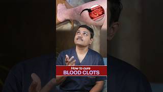 How to Treat Blood Clots Insights from vascularsurgeon shortvideo [upl. by Dagny617]