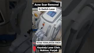 Laser Acne Scar Removal Treatment [upl. by Ear]