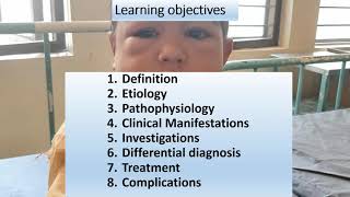 Nephrotic Syndrome  Pediatrics [upl. by Lattonia]