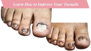 How to Nail Fungus Toenail Recovery 3rd Visit [upl. by Anawk]