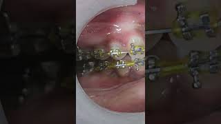 Results of class 2 elastics in 2 months orthodontist braces treatmentdentist real dentistry [upl. by Toh452]