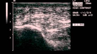 plantar fascia infiltrationwmv [upl. by Harlene]