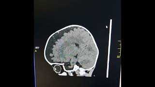 Agenesis of corpus callosum  External hydrocephalus [upl. by Flan]