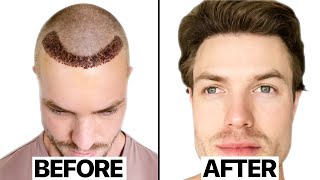 My Hair Transplant Results 6 Months  Surgeon Reacts [upl. by Harutek]