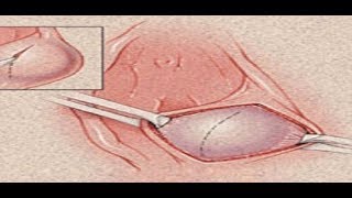 تشخيص كيسة بارثولين فى الفرج دمحمدجاد Bartholin’s cyst 2 الصحةالجنسية [upl. by Shanks]