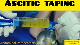 Ascitic taping  Abdominal Paracentesis  Peritoneal tap [upl. by Ahasuerus]