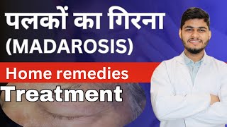 आख़ की पलकों का गिरना  Madarosis  Eyelashes Falling out remedies  Cause  Treatment [upl. by Llertnom]