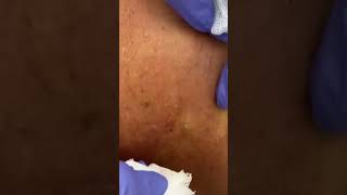 Epidermal cyst drainageepidermal [upl. by Nerro]