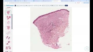 Avi Bitterman Dermpath Lecture 8 Granulomatous [upl. by Tessie]