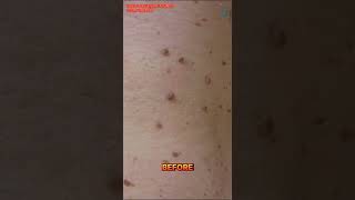 Skin Tag Removal by Laser [upl. by Gore]