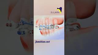 Upper Jaw Retraction Using First Molar Extraction bracs dentist orthodontics smile extraction [upl. by Anahsor123]