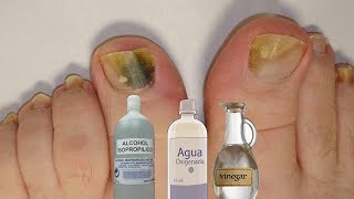 Fabrica tu propio “rompe hongos” natural para las uñas [upl. by Raybin94]