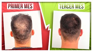 RECUPERA SU PELO en 3 MESES con DUTASTERIDE y MINOXIDIL ORAL [upl. by Tnomel]