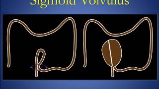 Cecal and sigmoid volvulus version 1 0 edit [upl. by Ynez]