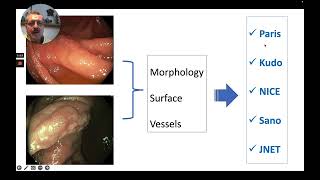 How to Endoscopically Characterize a Colon Polyp [upl. by Lionel338]