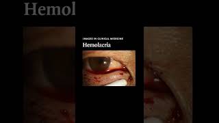 Hemolacria  NEJM [upl. by Tana246]